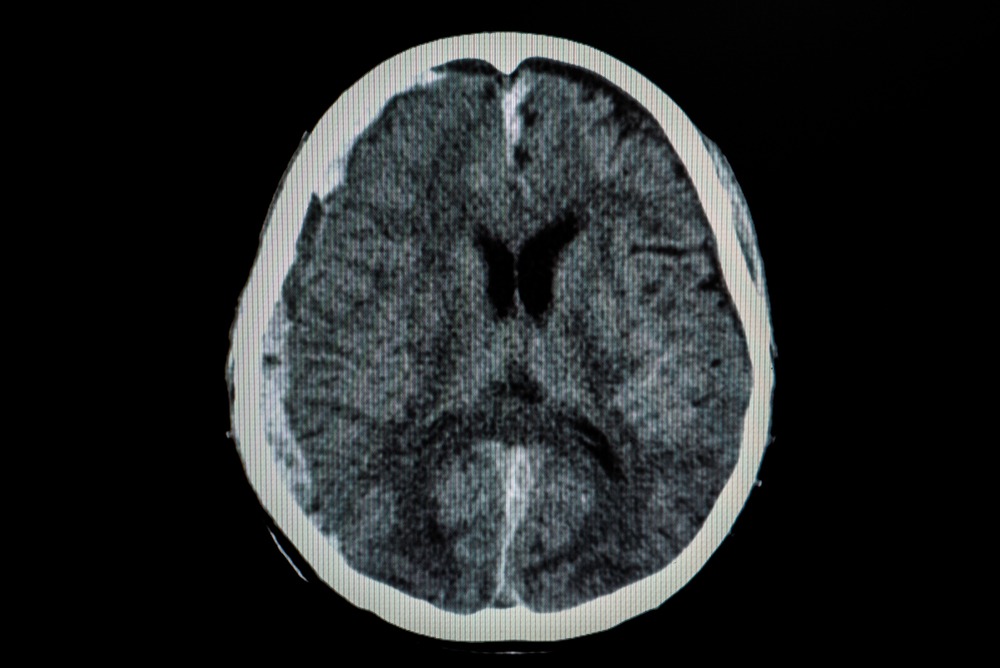 What to Expect from the TBI Recovery Process